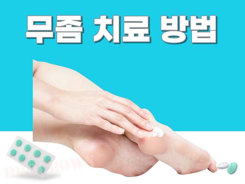 무좀 치료 방법