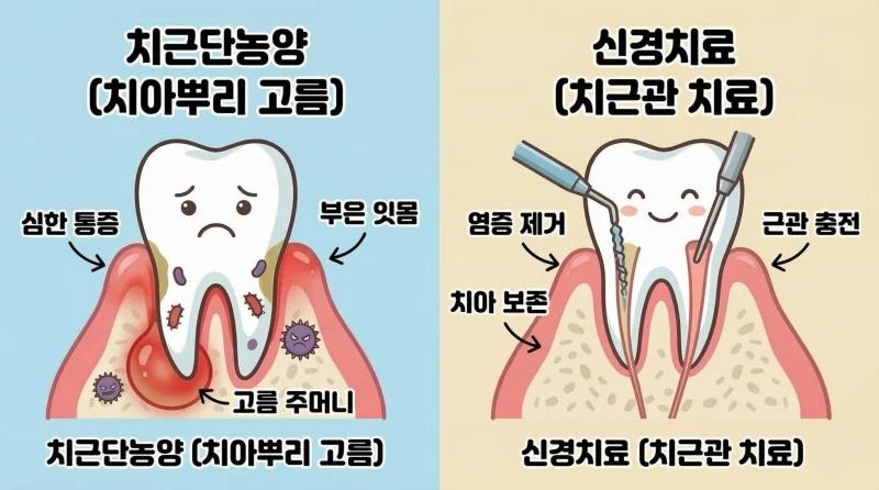 잇몸사이 고름 치료7 잇몸사이 고름 신경치료