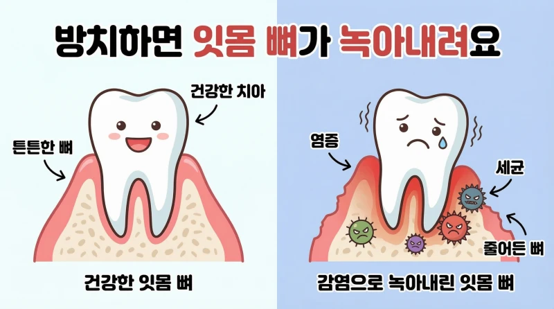 잇몸사이 고름13 잇몸사이 고름