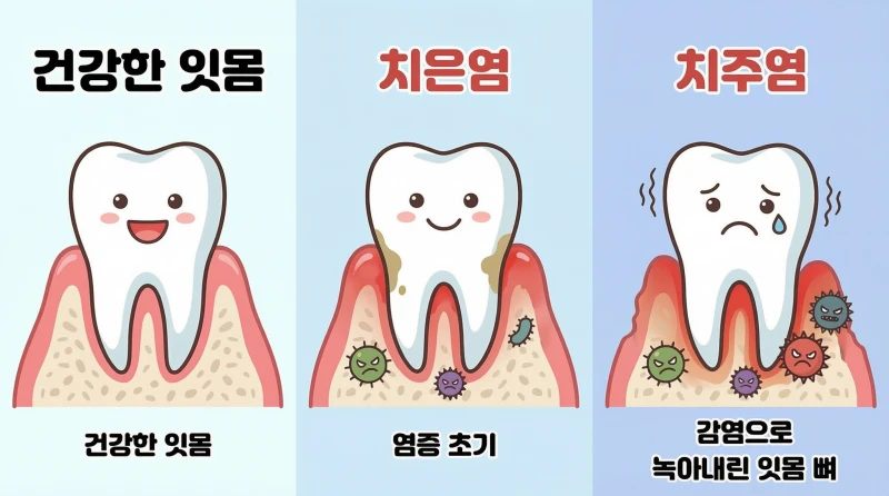잇몸사이 고름7 잇몸사이 고름