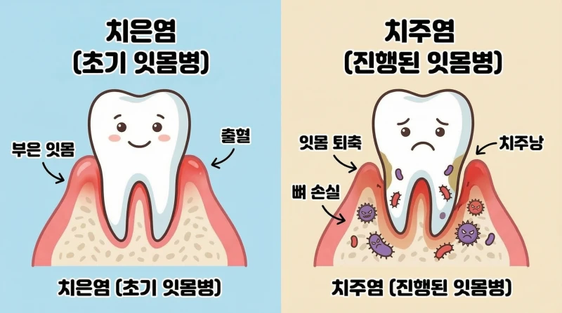 잇몸사이 고름8 잇몸사이 고름